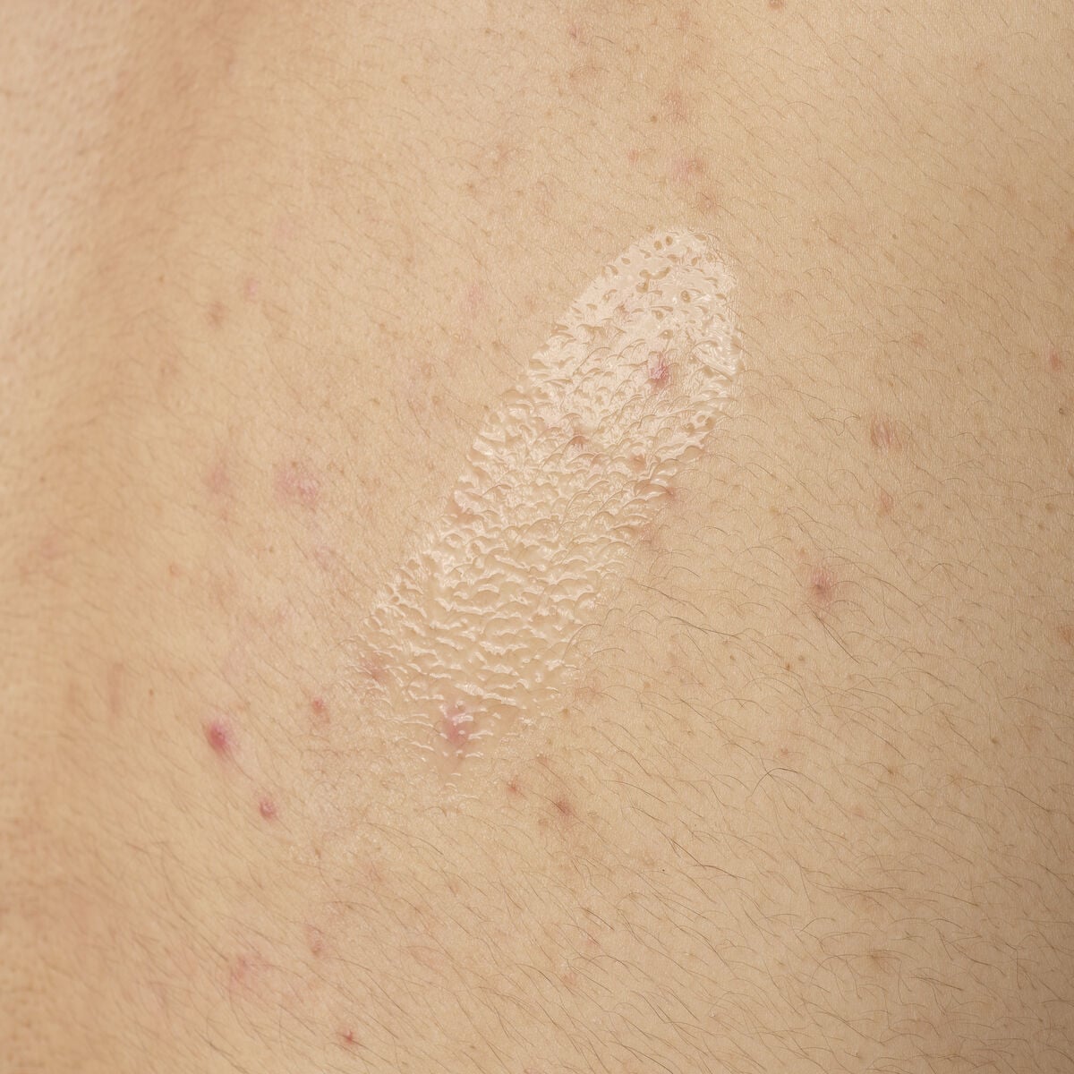 salicylic-acid-0-5-body-serum-x5 ORD-salicylic-acid-05-body-240ml-application.jpg