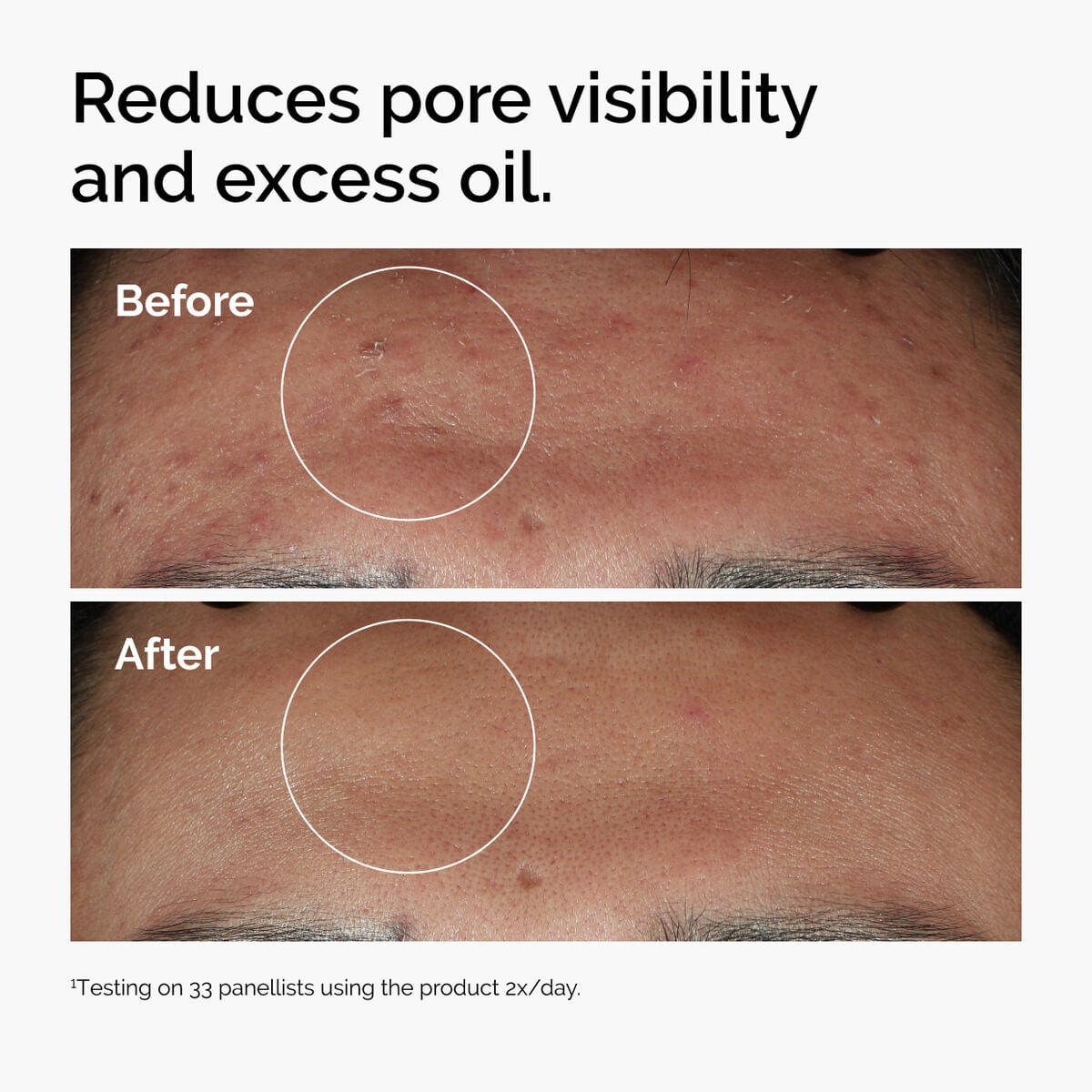 niacinamide-10-zinc-1-e7 ord-niacinamide-zinc-blemish-serum-before-after-pores.jpg