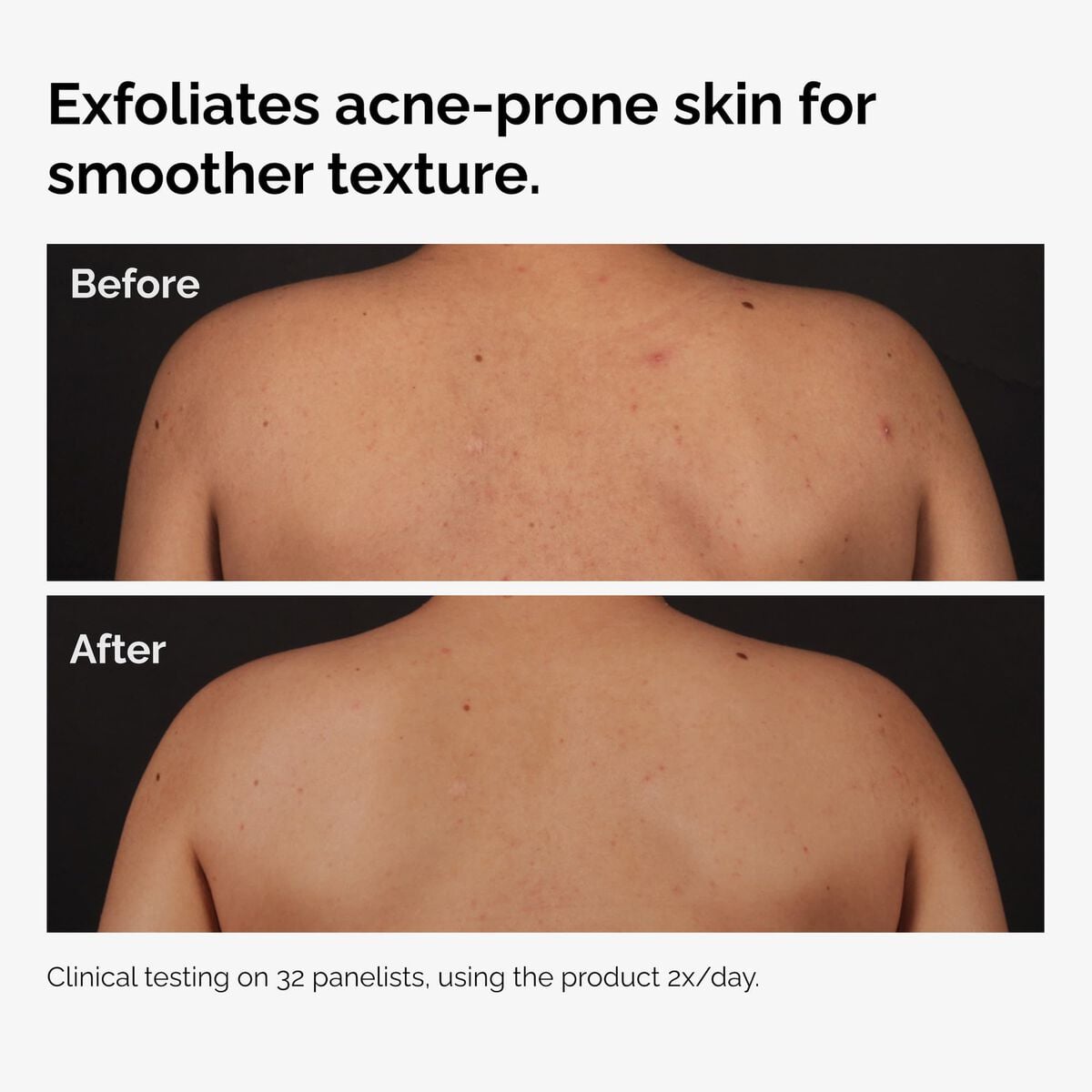 salicylic-acid-0-5-body-serum-x5 ord-salicylic-acid-body-serum-before-after-graphic-NA.jpg